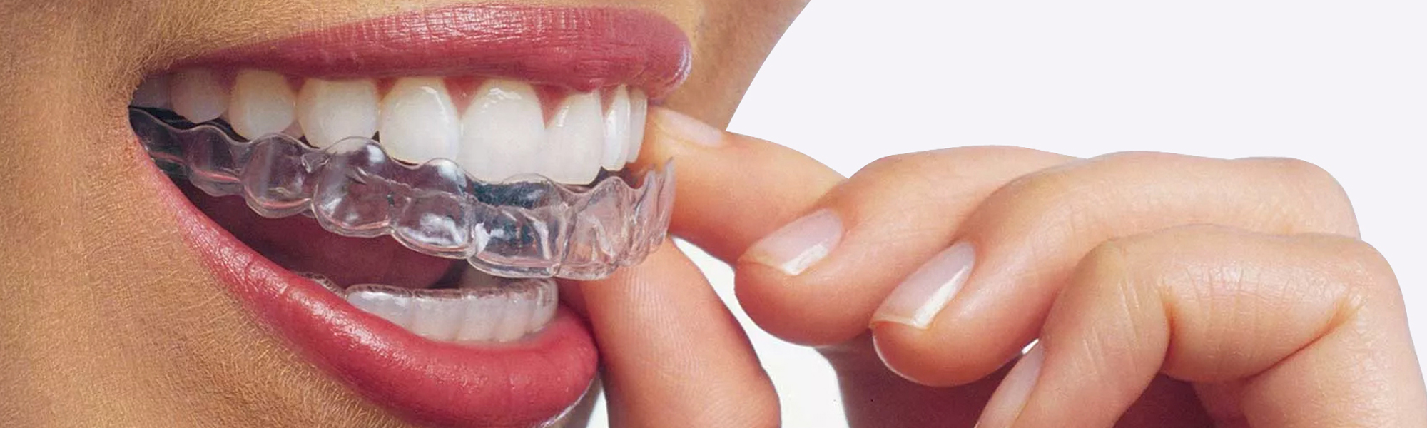 Invisalign Dental Aligners